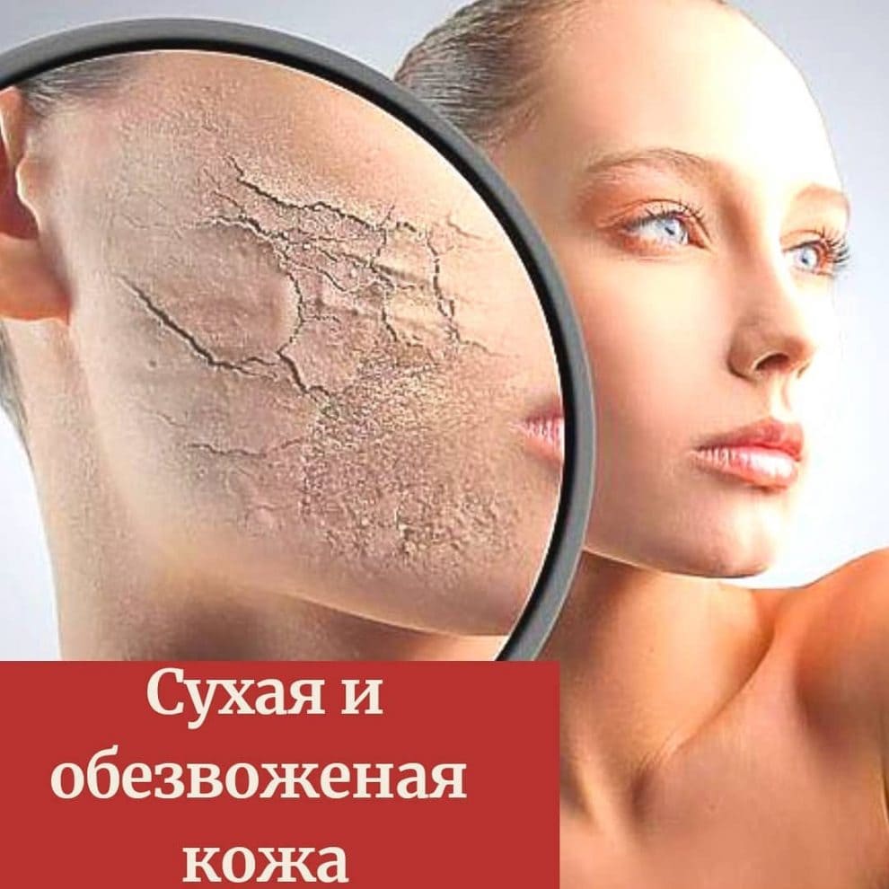 Сухая и обезвоженная кожа