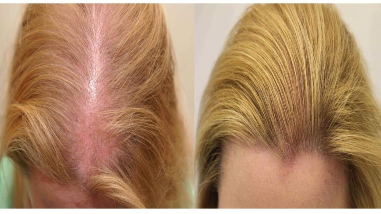 Как прекратить выпадение волос с помощью натуральных средств