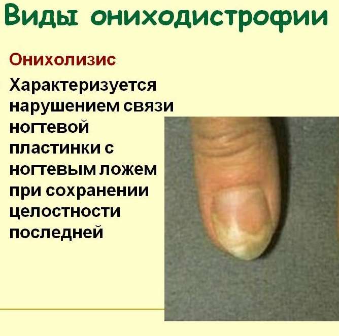 Онихолизис после гель-лака
